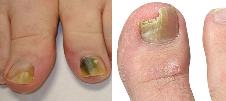 Onychomycosis - Καταστροφή των νυχιών με μύκητα